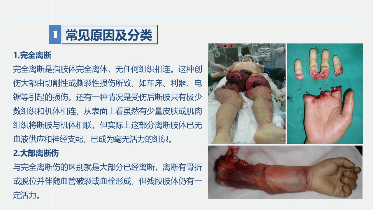 骨科-肢体离断伤的护理查房