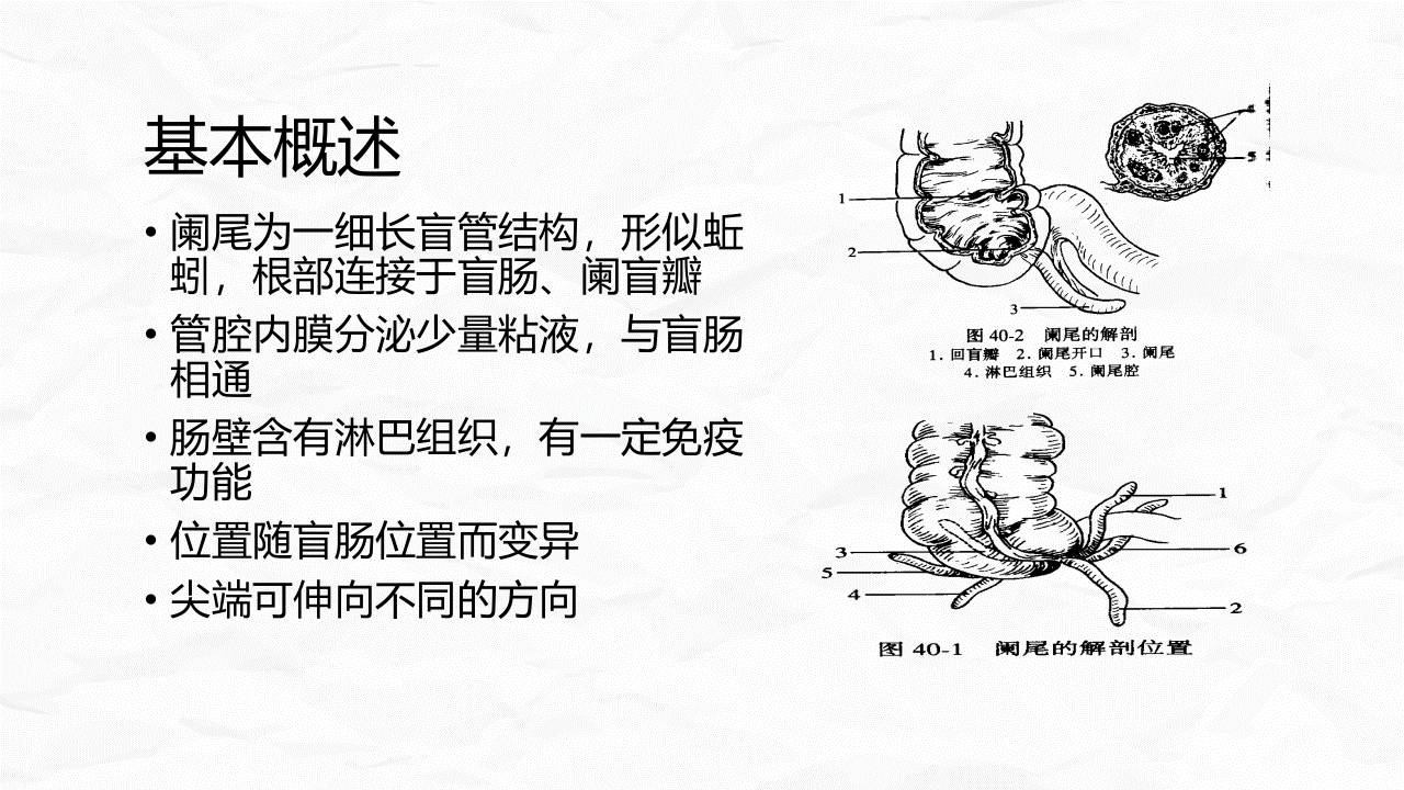 急性阑尾炎护理查房