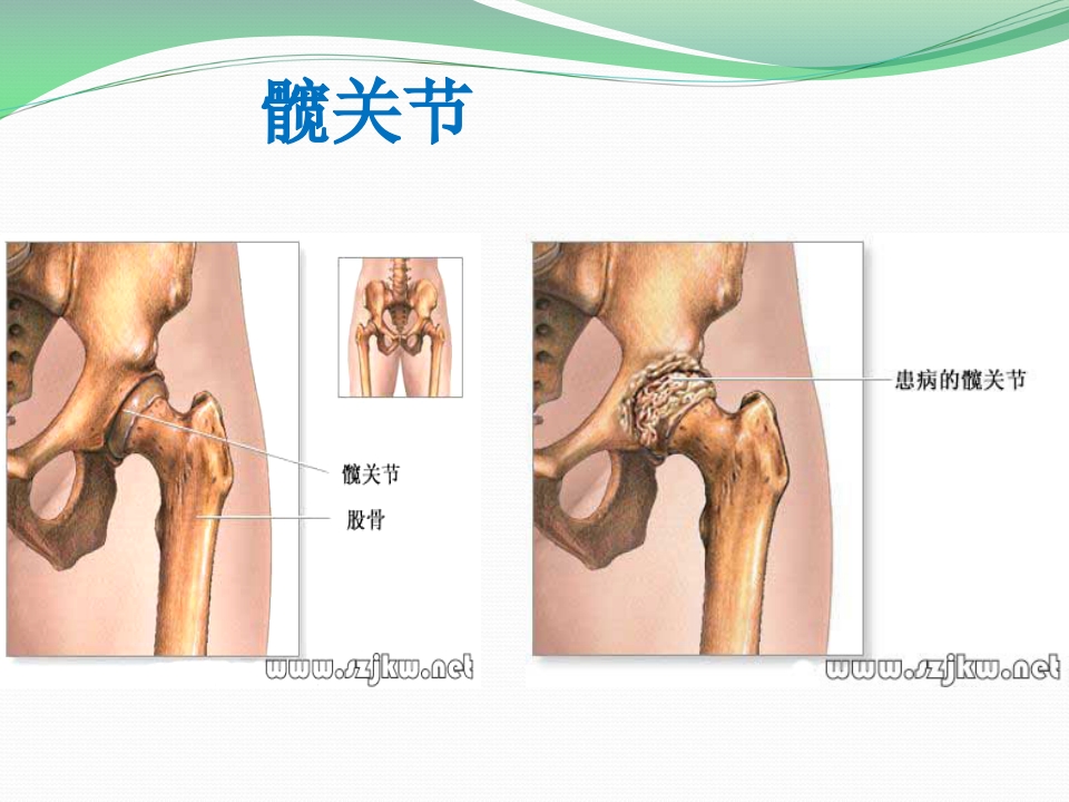 髋关节置换护理