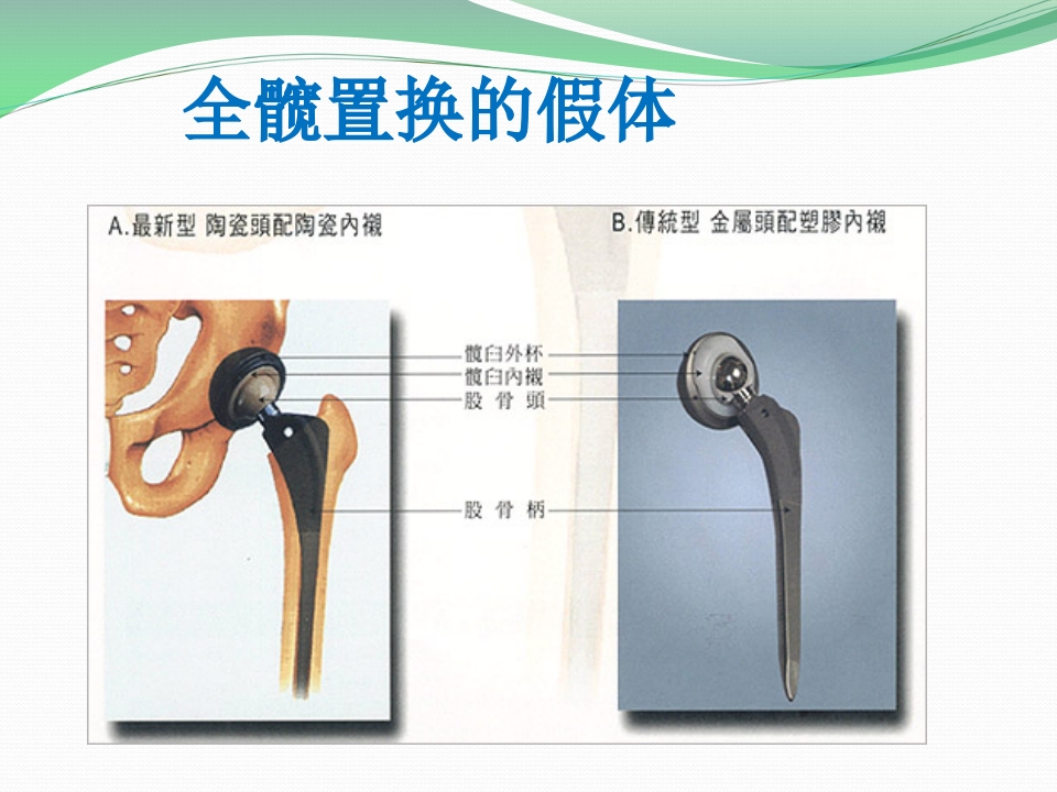 髋关节置换护理
