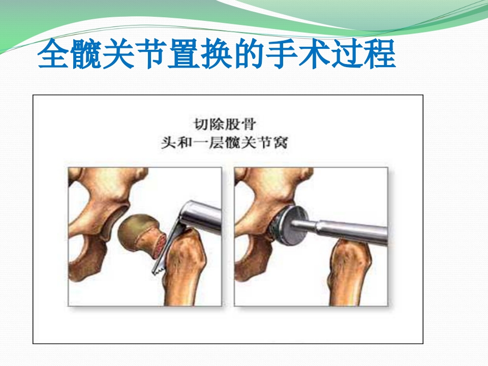 髋关节置换护理