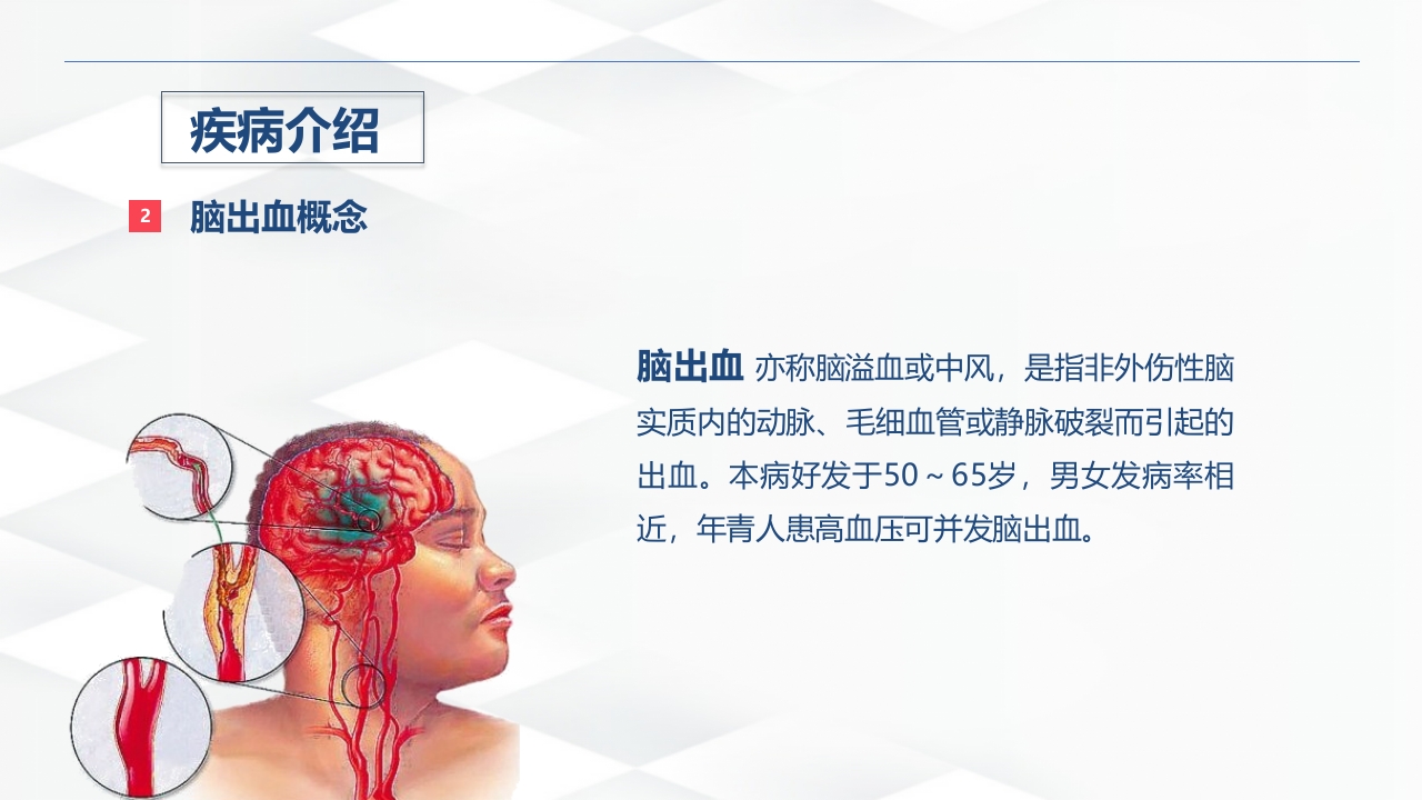 脑出血的术后护理