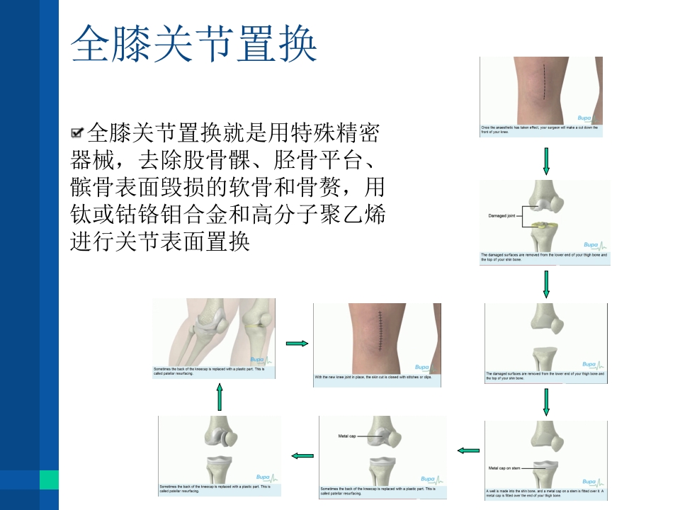 膝关节置换术后康复护理