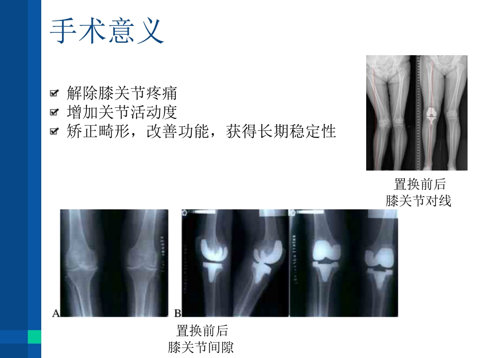 膝关节置换术后康复护理