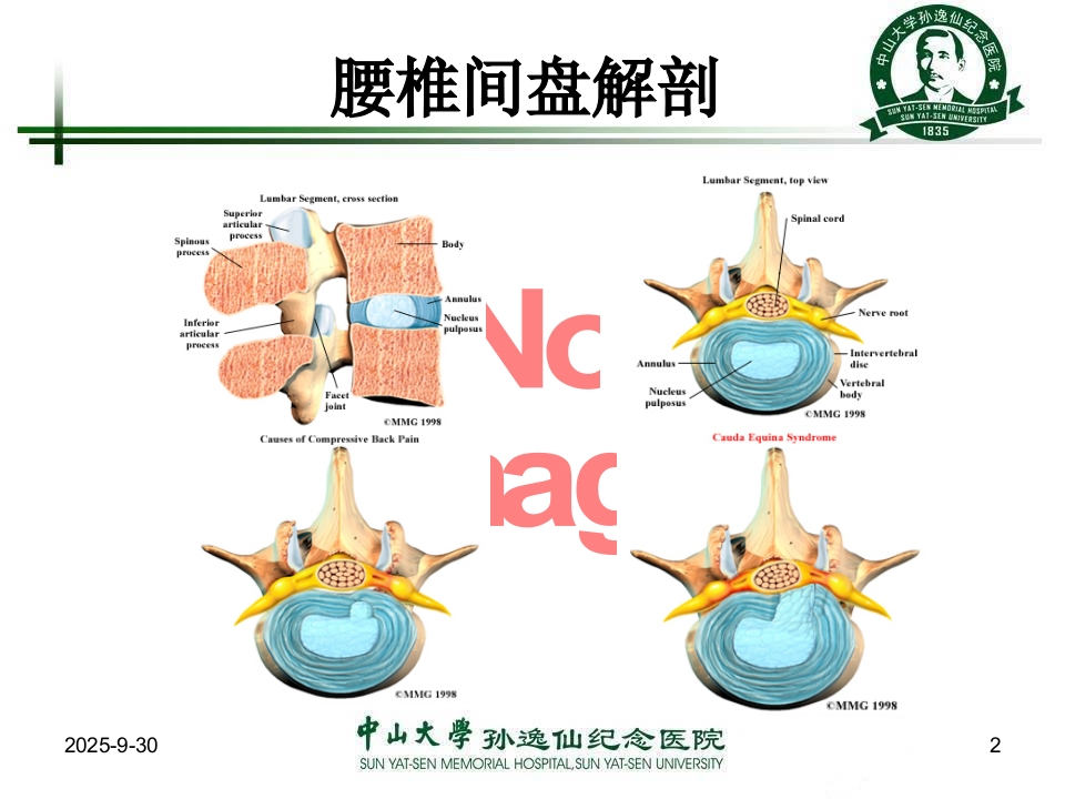 腰椎间盘突出症的康复