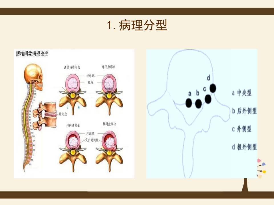 腰椎间盘突出症的预防和自我护理