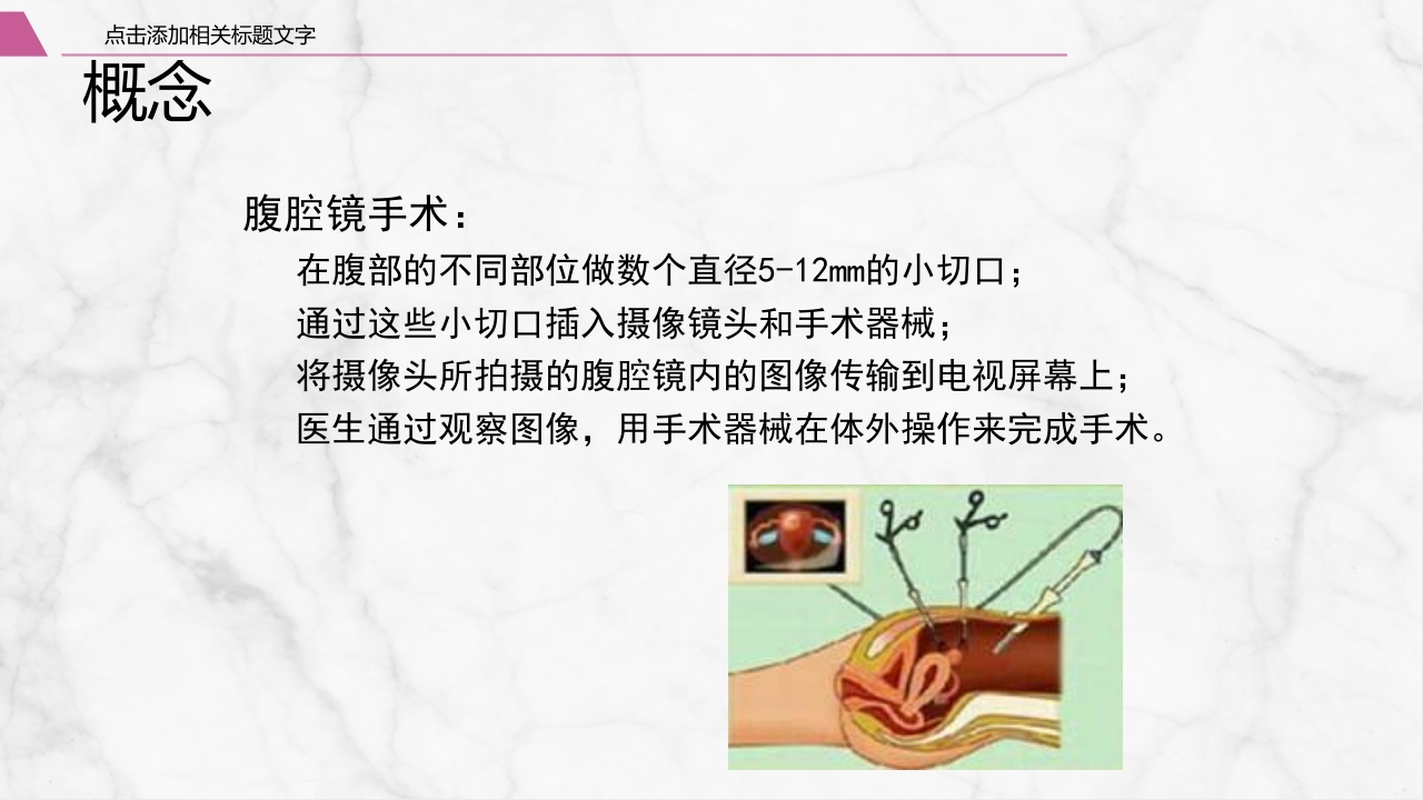 腹腔镜围手术期护理