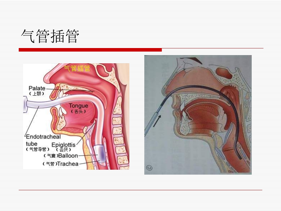 经口气管插管术
