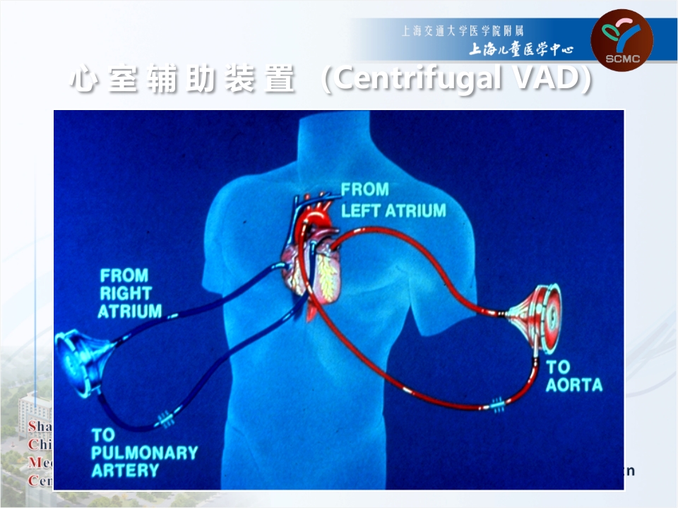 体外生命支持设备在重症监护室的使用CICU