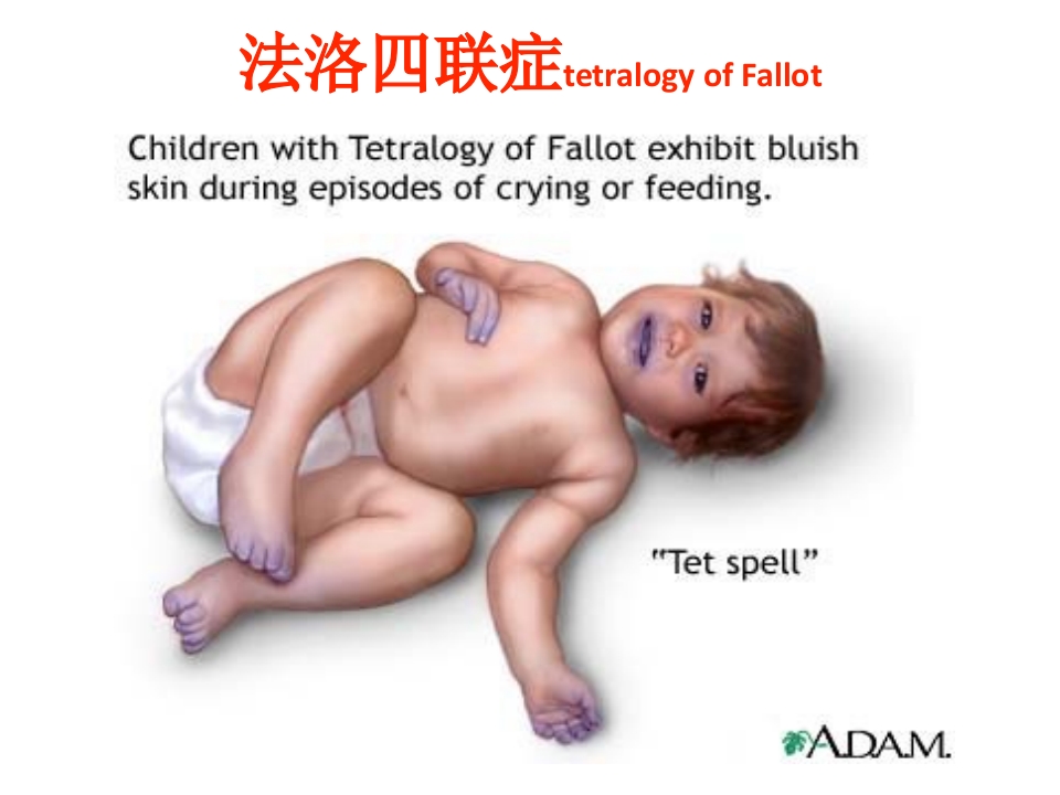 心脏疾病外科术后患儿护理