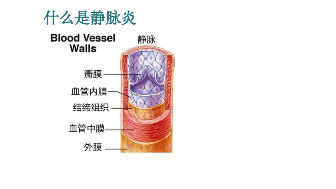 静脉炎的预防及护理ppt