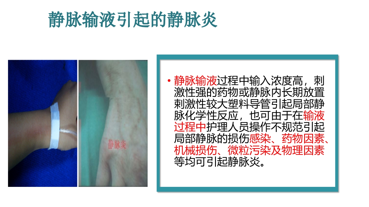静脉炎的预防及护理ppt