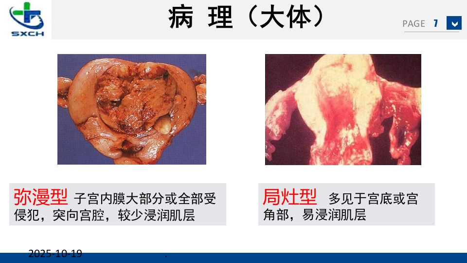 子宫内膜癌的诊治PPT课件