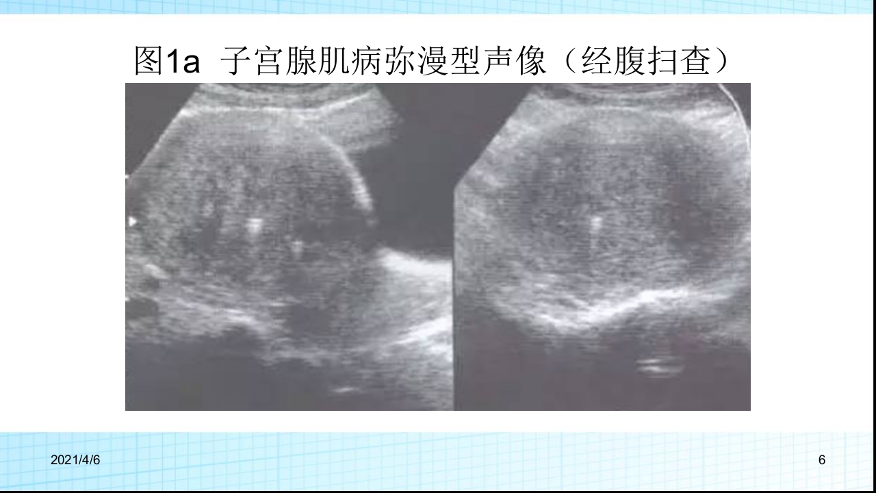 子宫腺肌症的超声诊断