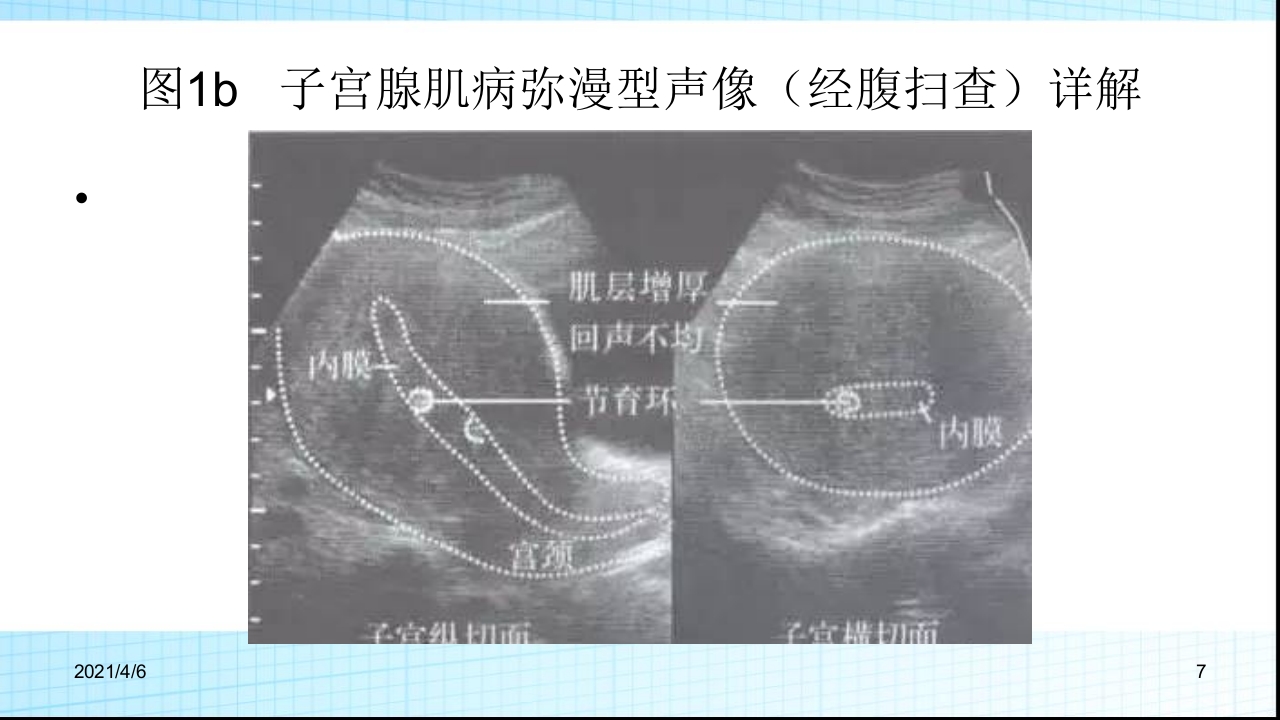 子宫腺肌症的超声诊断