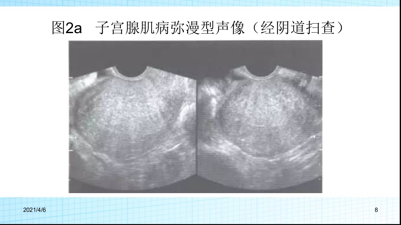 子宫腺肌症的超声诊断