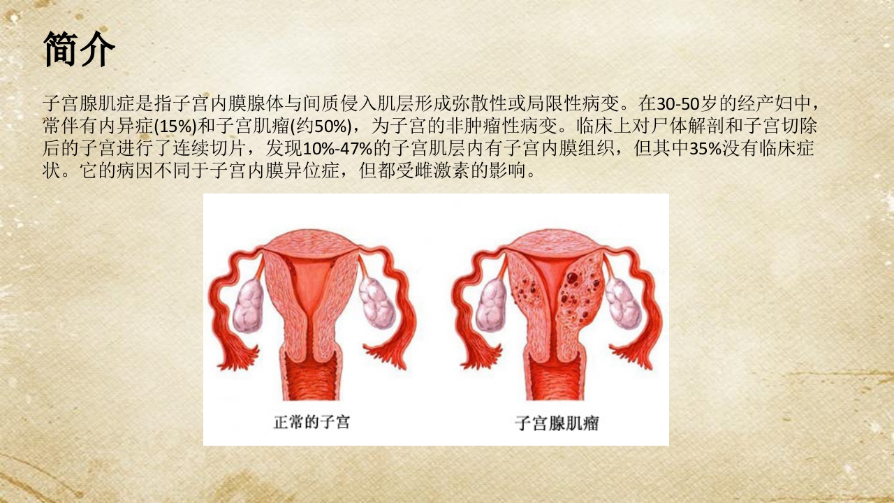 子宫腺肌症综述ppt课件