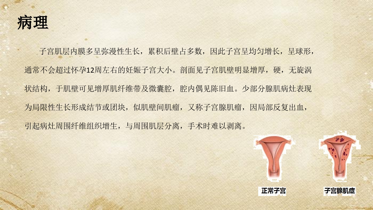 子宫腺肌症综述ppt课件