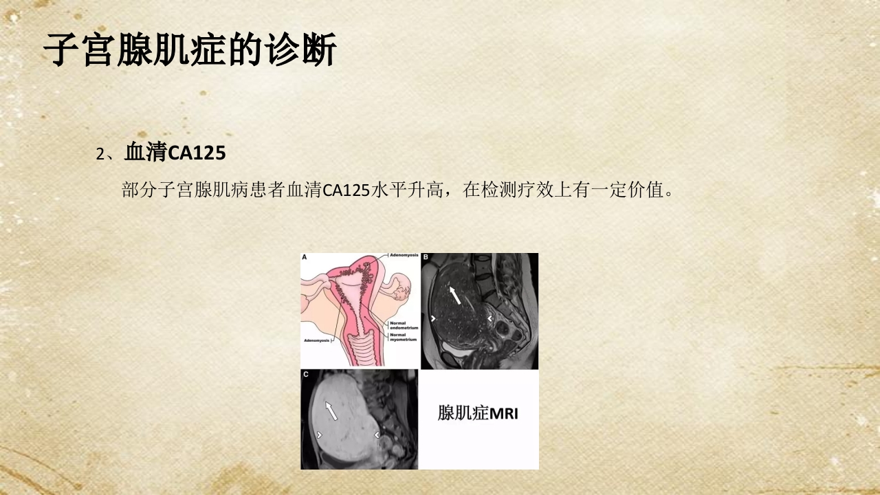 子宫腺肌症综述ppt课件