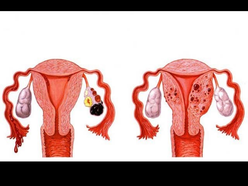 子宫腺肌症课件