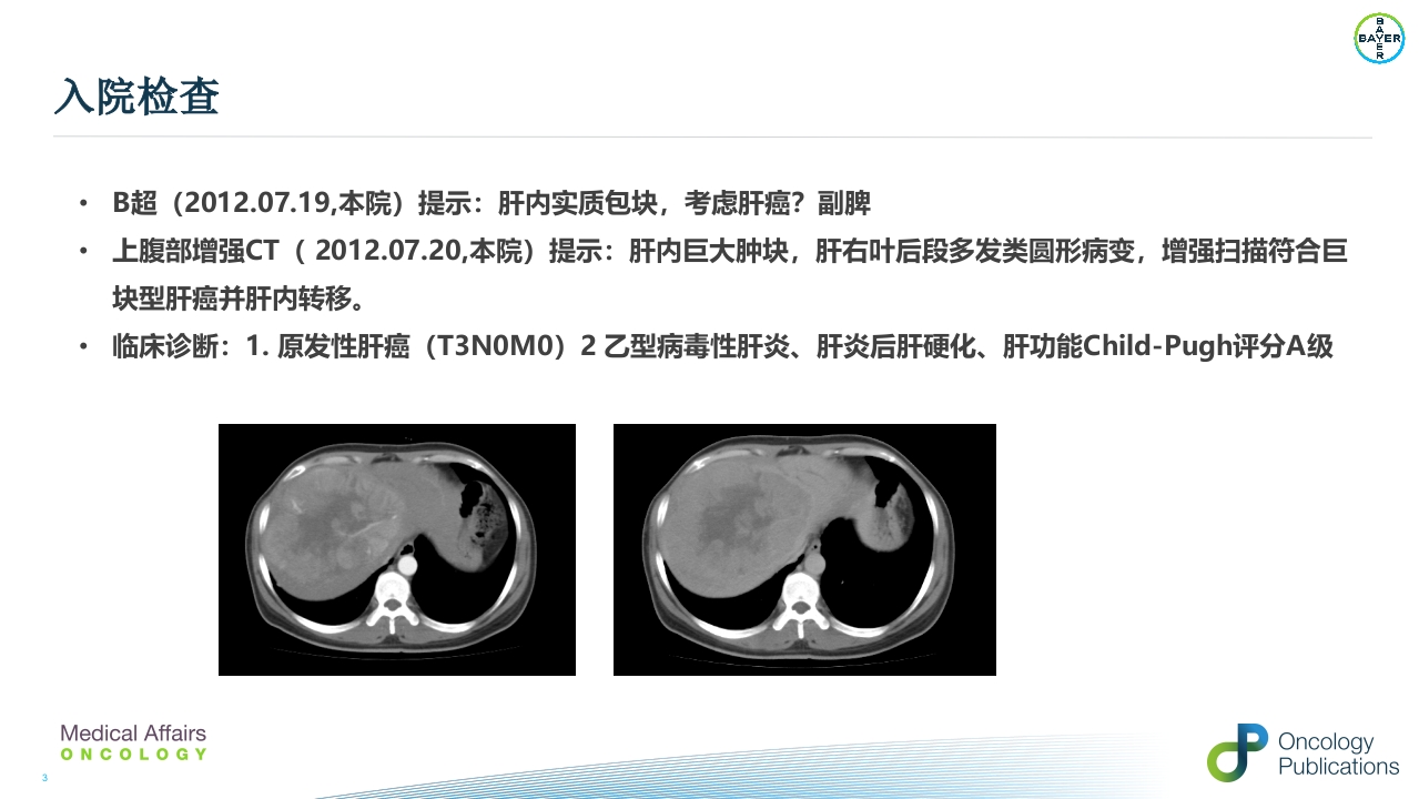 例子-周波--肝癌二线治疗瑞戈非尼重庆pptx()