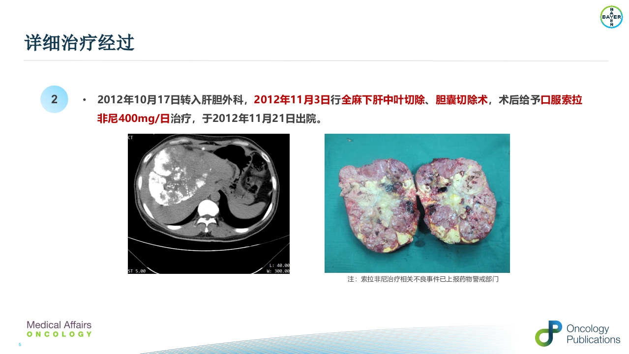 例子-周波--肝癌二线治疗瑞戈非尼重庆pptx()