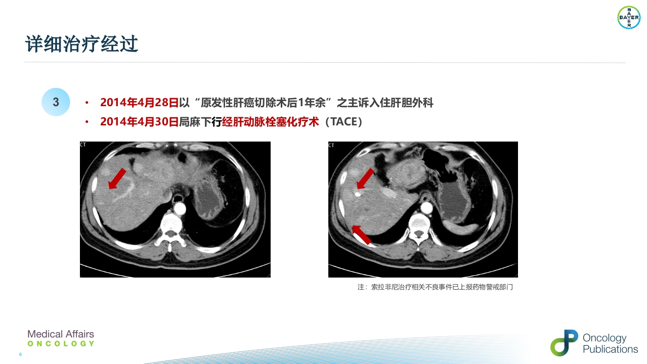 例子-周波--肝癌二线治疗瑞戈非尼重庆pptx()