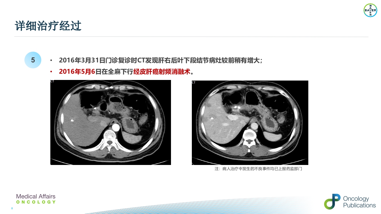 例子-周波--肝癌二线治疗瑞戈非尼重庆pptx()