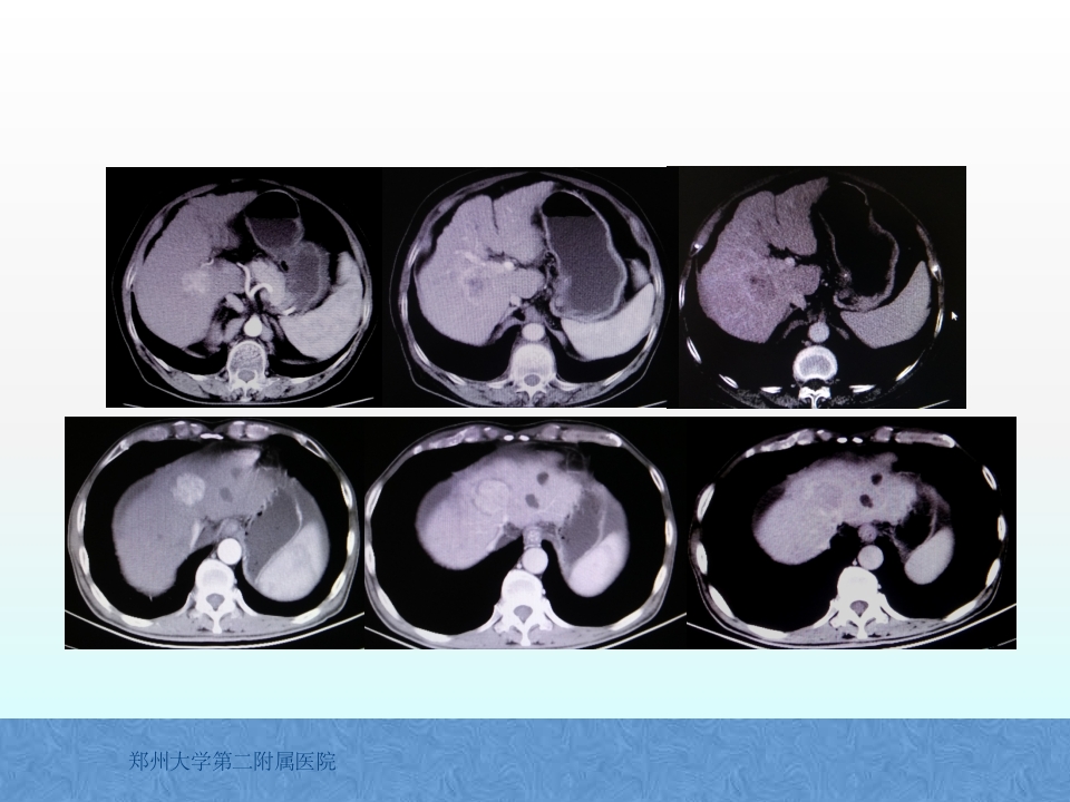 原发性肝癌诊疗指南解读