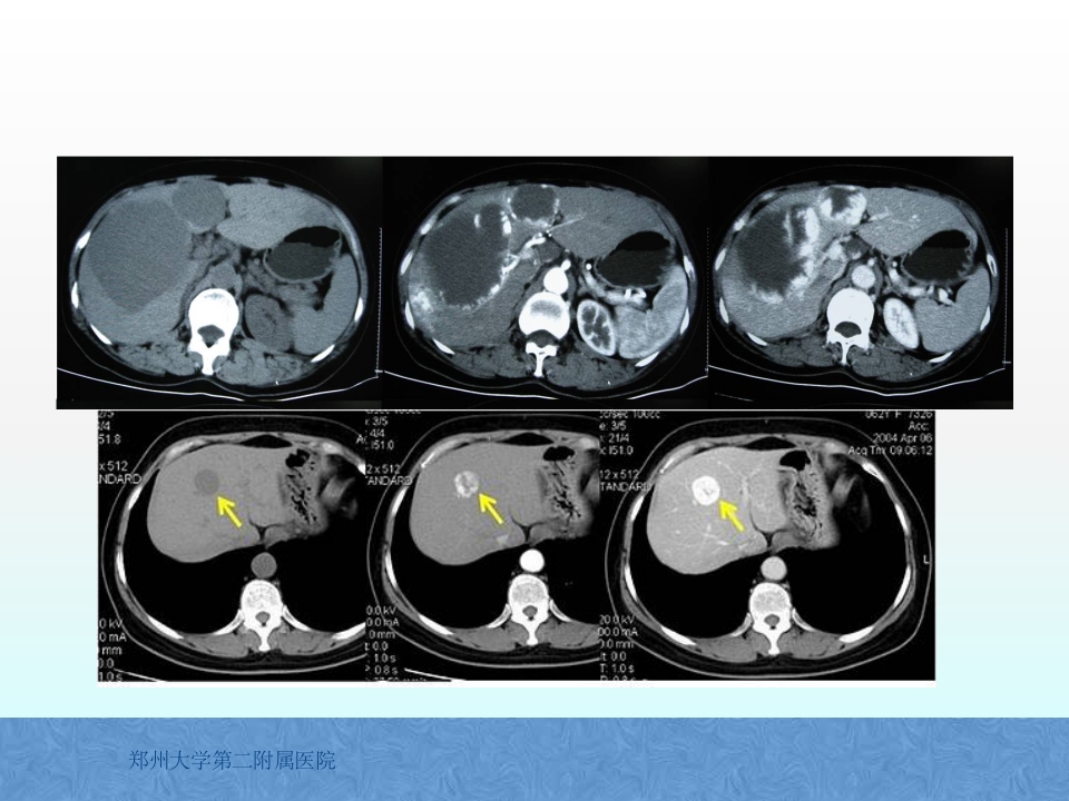 原发性肝癌诊疗指南解读