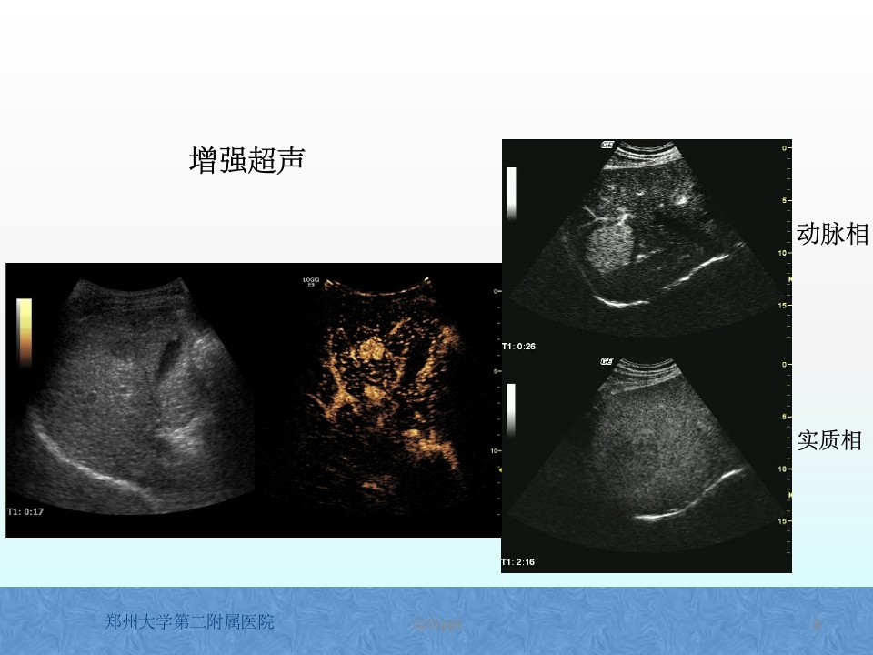原发性肝癌诊疗指南解读