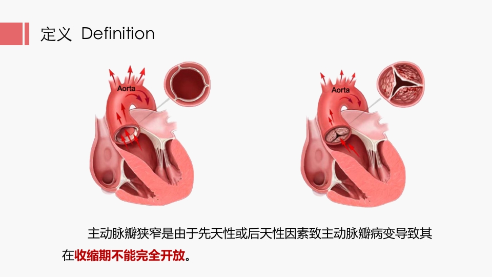 北京高校青年教师教学比赛获奖课件-医学类-主动脉瓣狭窄【27页】_20324130