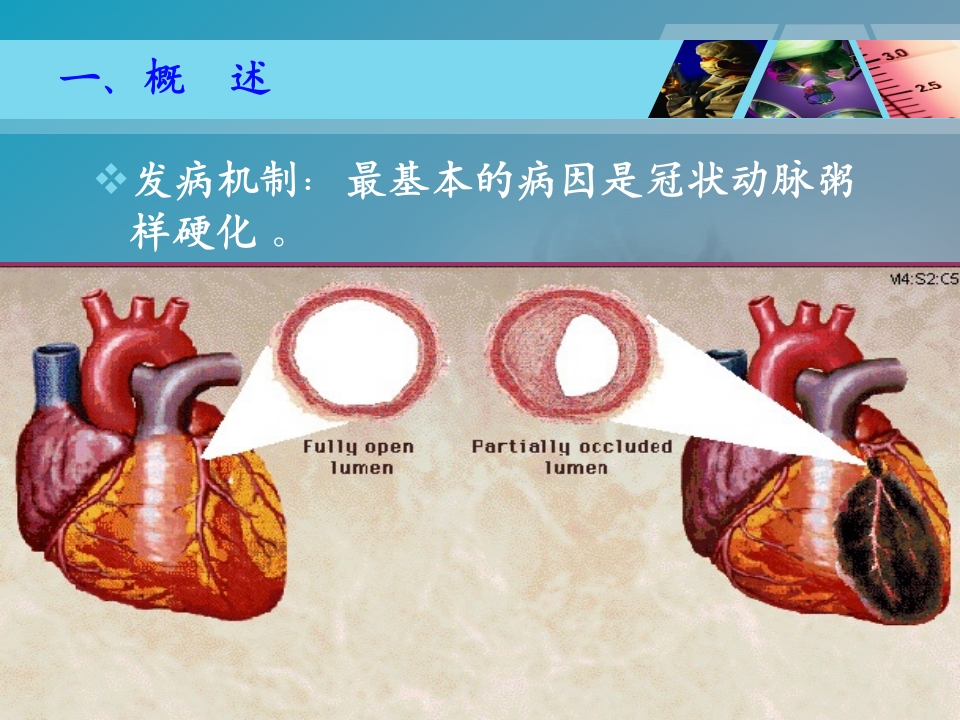 全国“创新杯”医药卫生类类说课大赛课件特等奖作品：心肌梗死课件