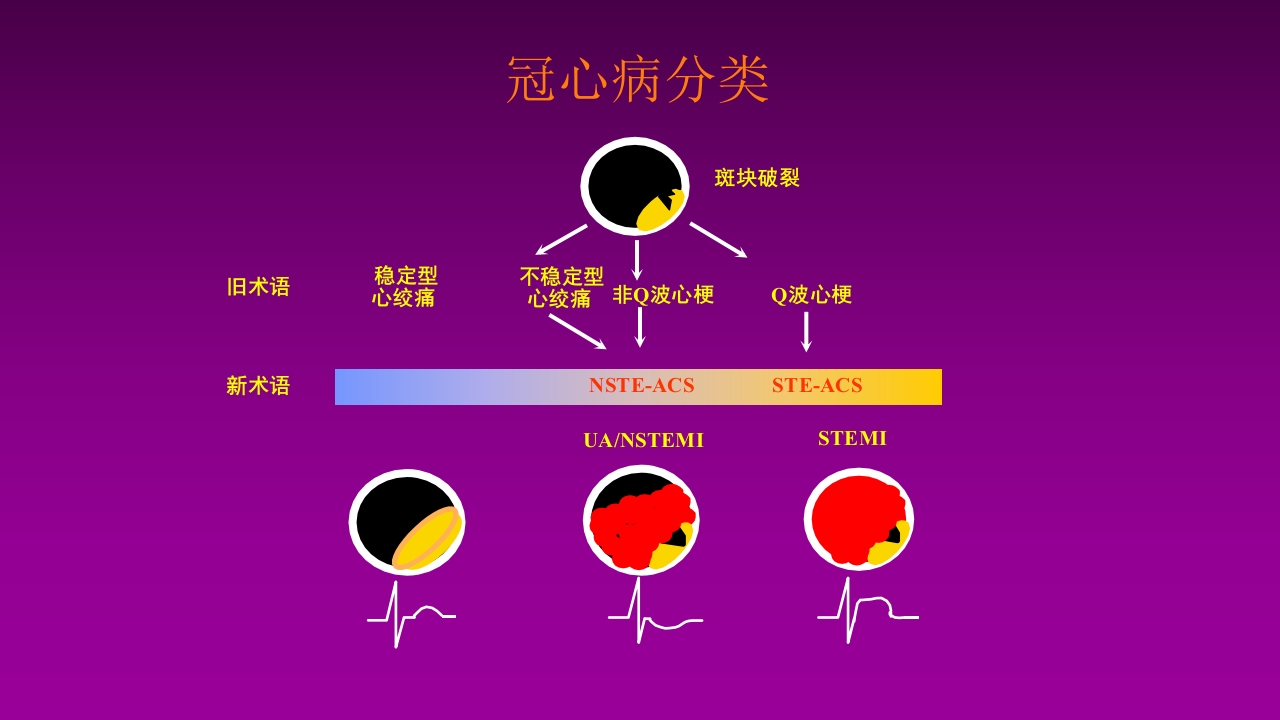 医学大赛一等奖《急性心肌梗死的治疗原则(AMI)》讲课课件