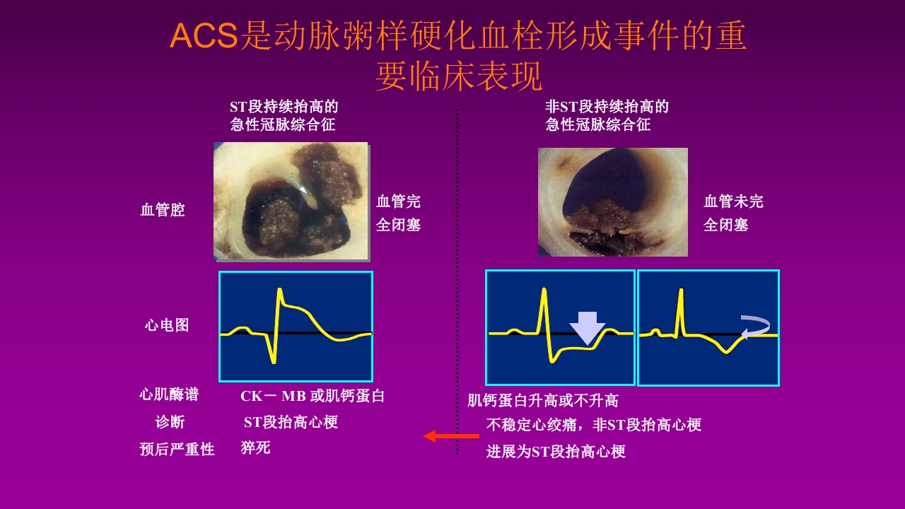 医学大赛一等奖《急性心肌梗死的治疗原则(AMI)》讲课课件