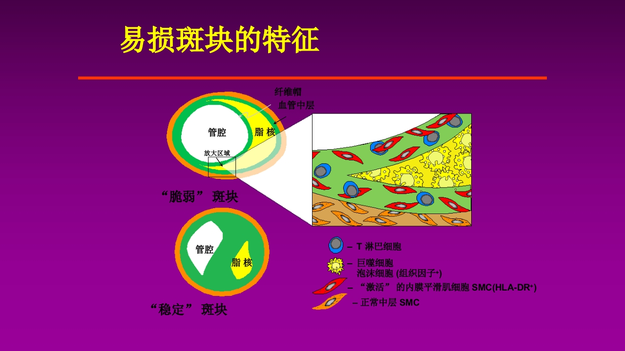 医学大赛一等奖《急性心肌梗死的治疗原则(AMI)》讲课课件