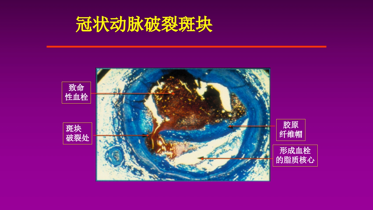 医学大赛一等奖《急性心肌梗死的治疗原则(AMI)》讲课课件