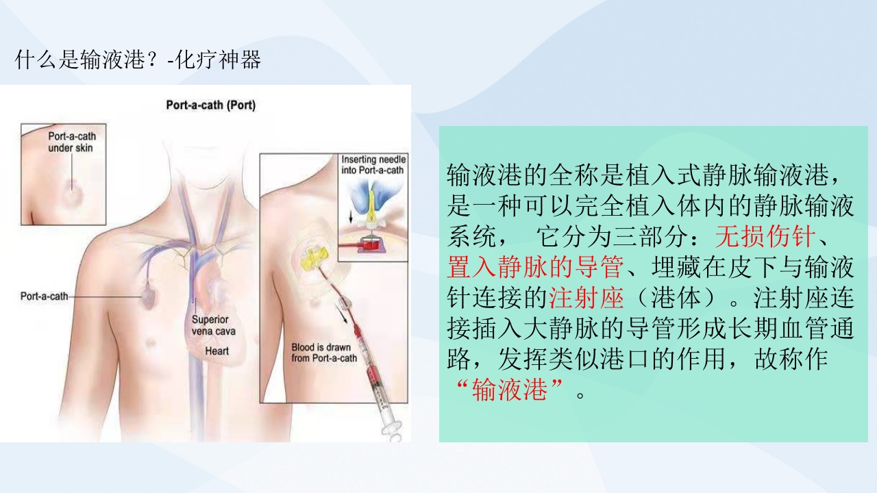 植入式静脉输液港的并发症及护理