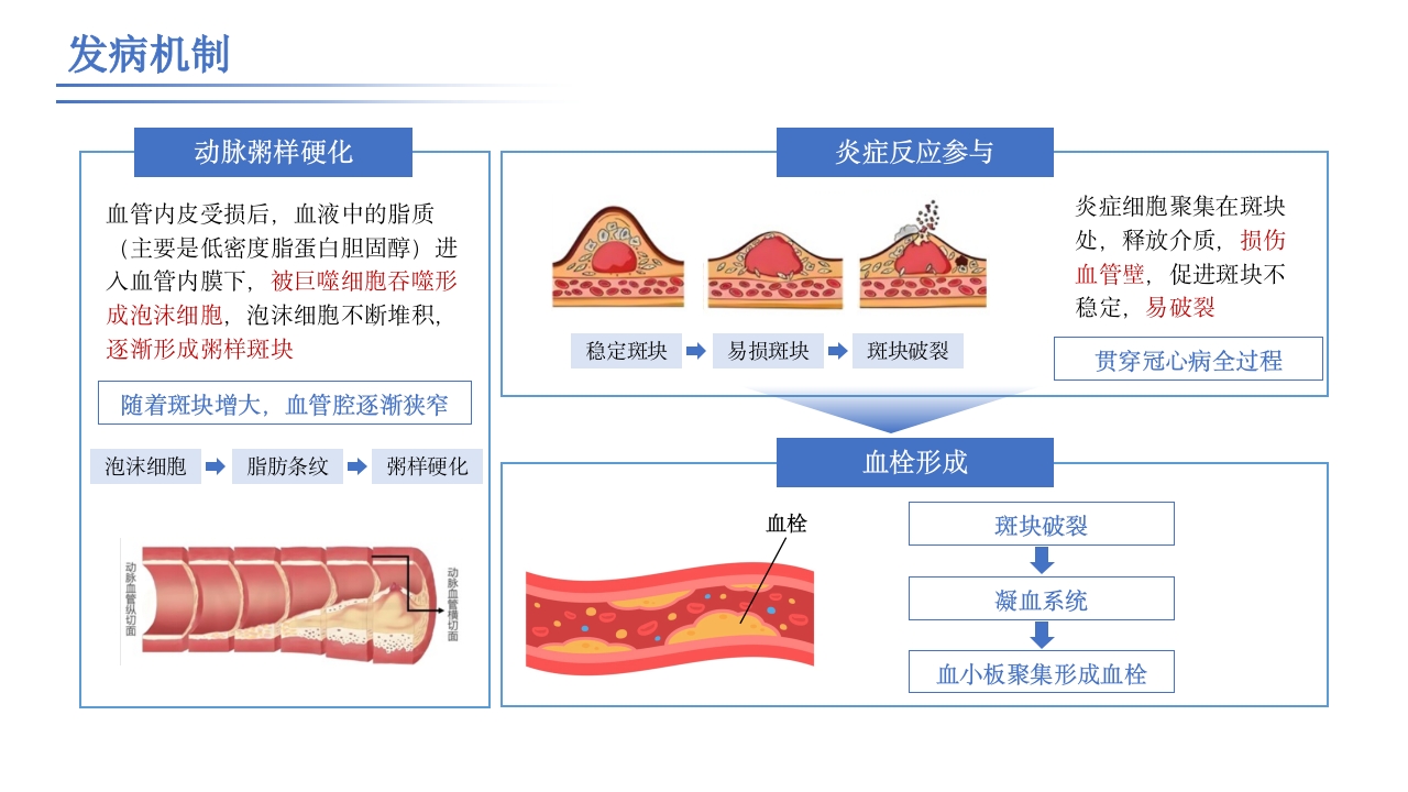 破解冠心病防治密码