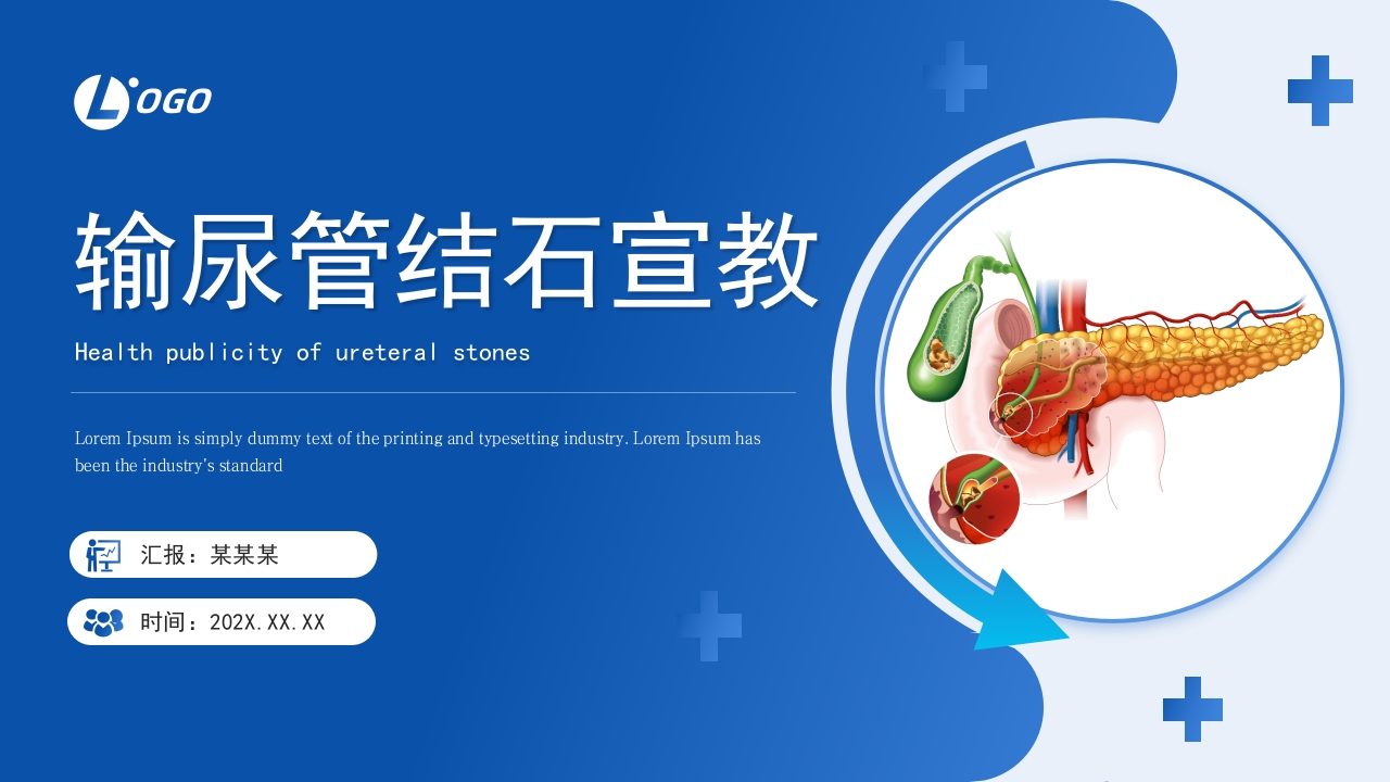 输尿管结石健康宣教