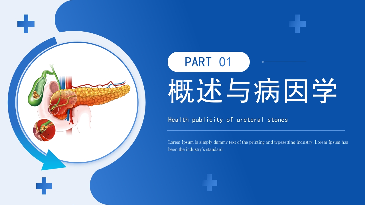 输尿管结石健康宣教