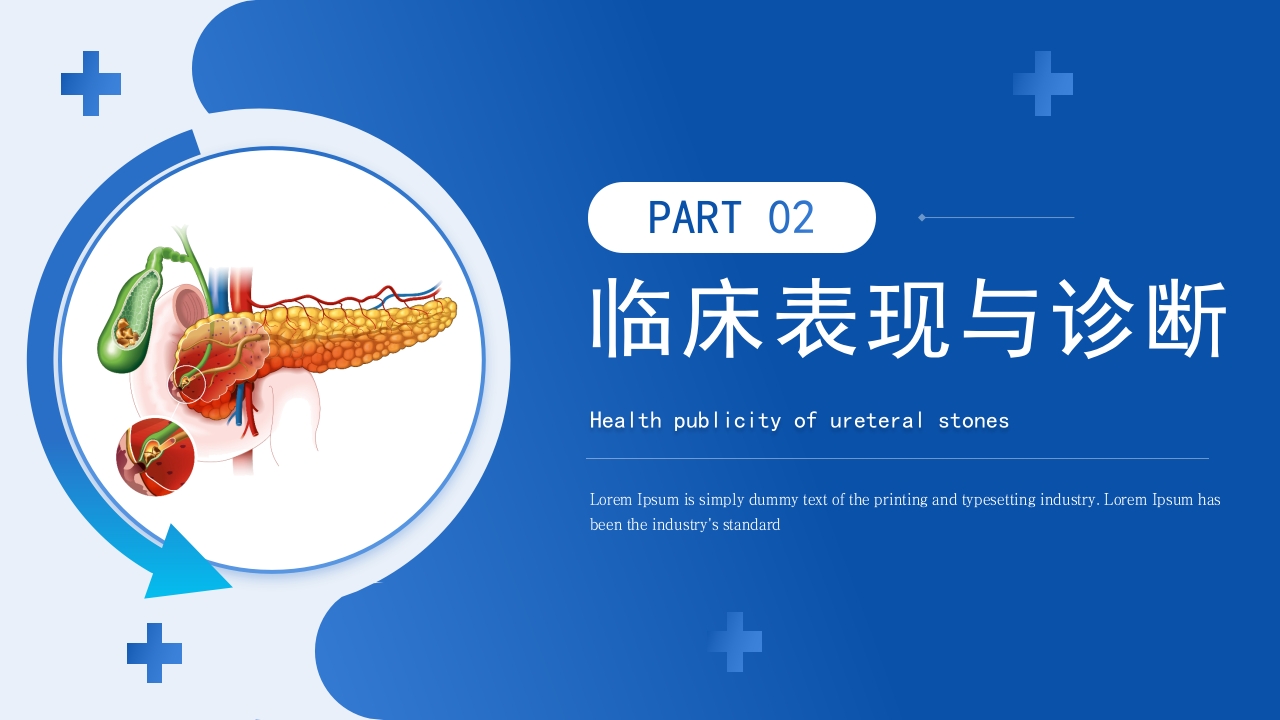 输尿管结石健康宣教